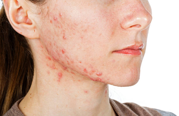 Portrait of young girl with skin problem acne on jawline how to treat acne best treatment for acne micro needling for acne treatment best skincare to treat acne oily skin blackheads and whiteheads teenage acne