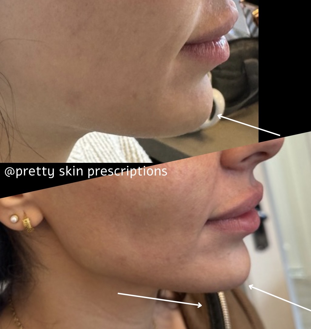 Picture of a lady having a dermal filler chin enhancement