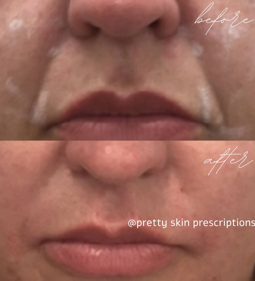 Picture of a patient with deep nato-labial folds smile lines treated with dermal filler